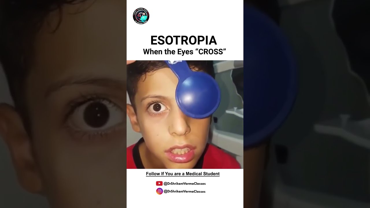 Esotropia Explained: From Symptoms to Treatment for Aspiring Doctors