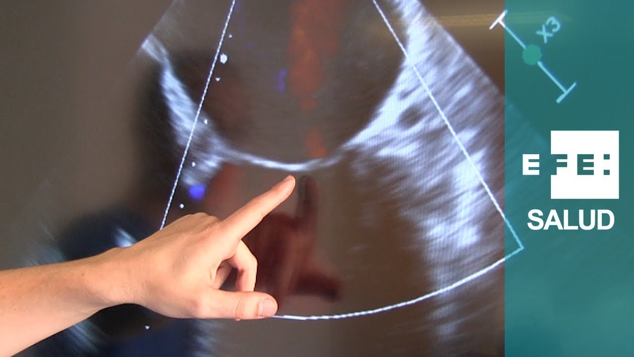 Corrección de la insuficiencia mitral con Mitraclip