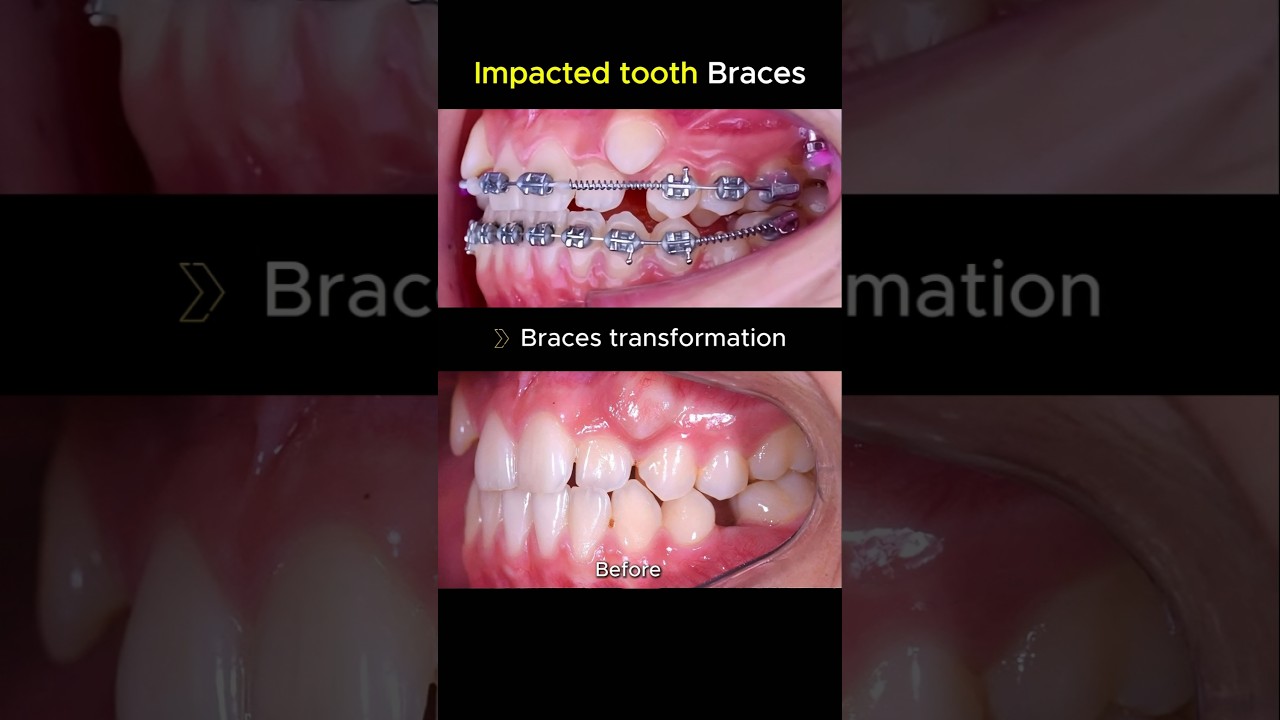 Braces transformation. impacted and crooked teeth treatment #braces #dentist