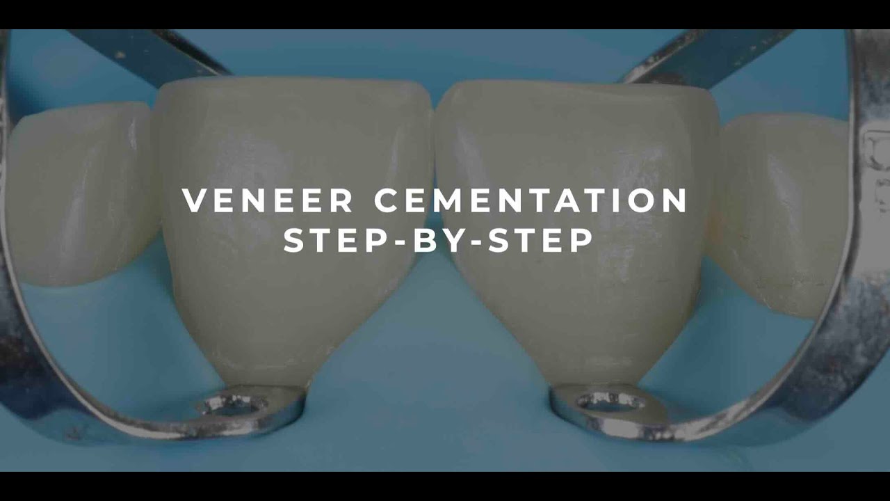 Veneer cementation - Step by step