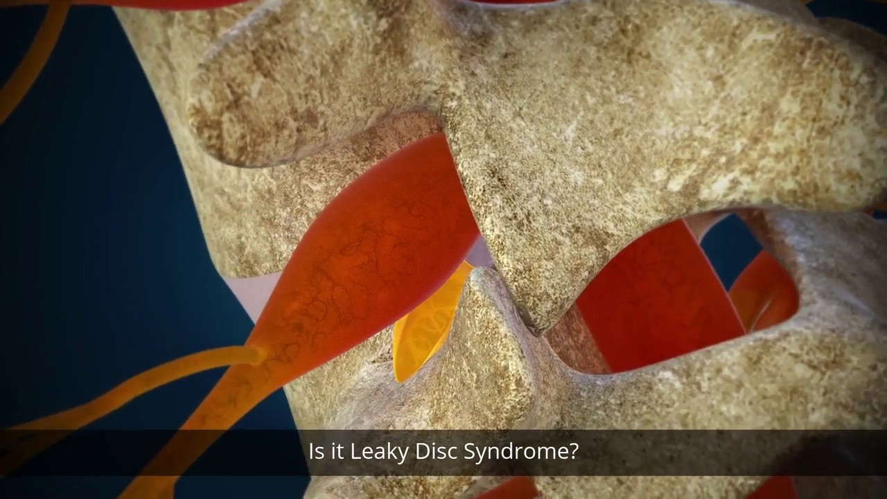 How the Minimally Invasive Spinal Fusion Alternative Discseel® Procedure works.