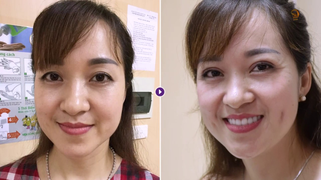 Cảm nhận của khách hàng sau 13 ngày thực hiện combo nhấn mí + tạo má lúm | Dr Hoàng Tuấn