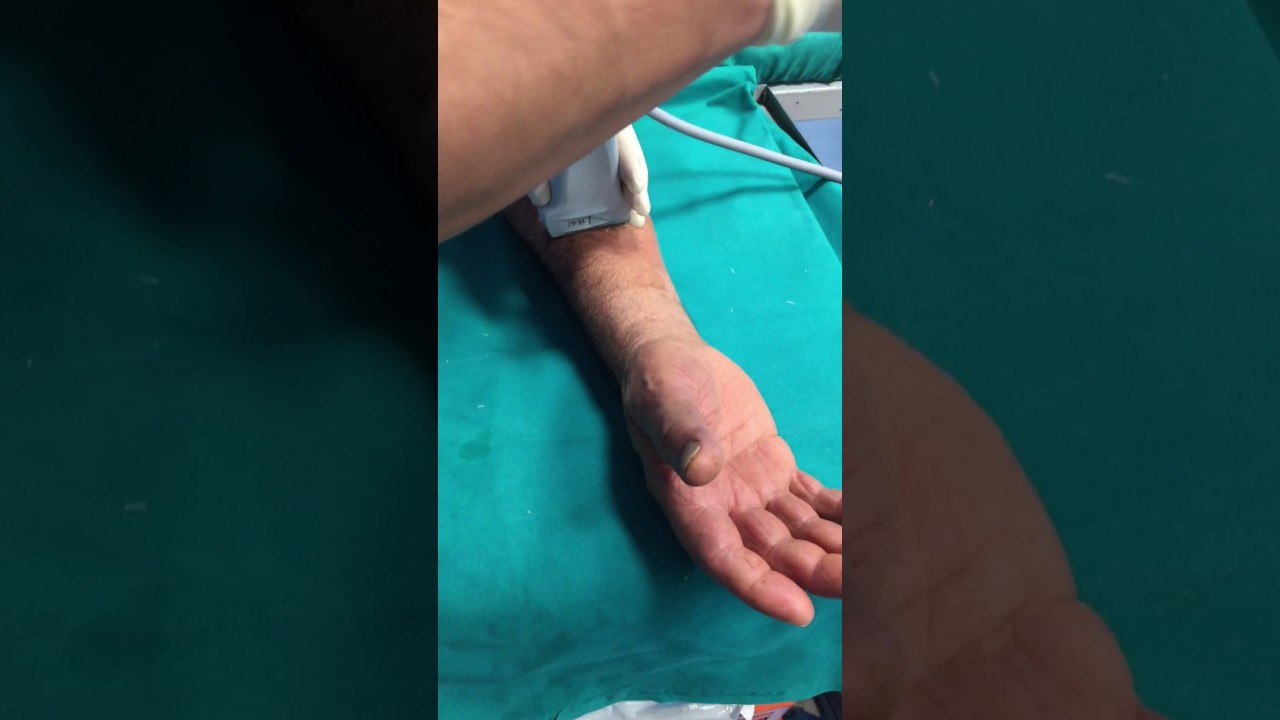 Sonoanatomia forearm