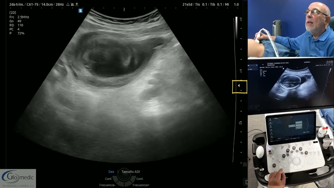 Ajustes en el mejoramiento de la imagen en 2D y Doppler. Ecógrafo V8.