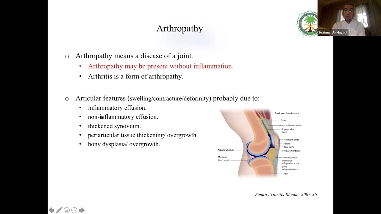 MIMICS of juvenile idiopathic arthritis. prof Sualiman Almayouf