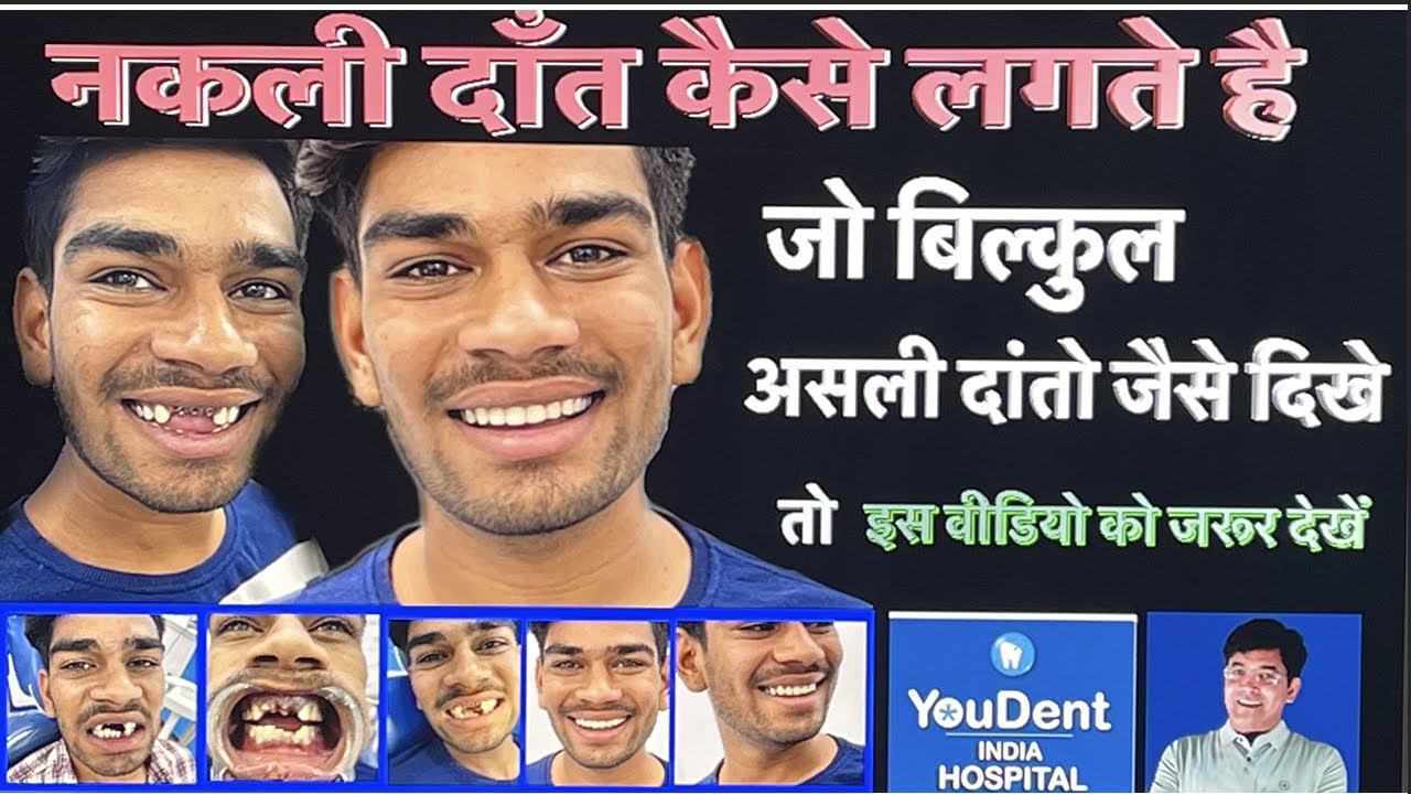 BEST TREATMENT FOR BROKEN TEETH ,YOUDENT HOSPITAL JAIPUR.BEST DENTAL  IMPLANT CENTRE IN INDIA