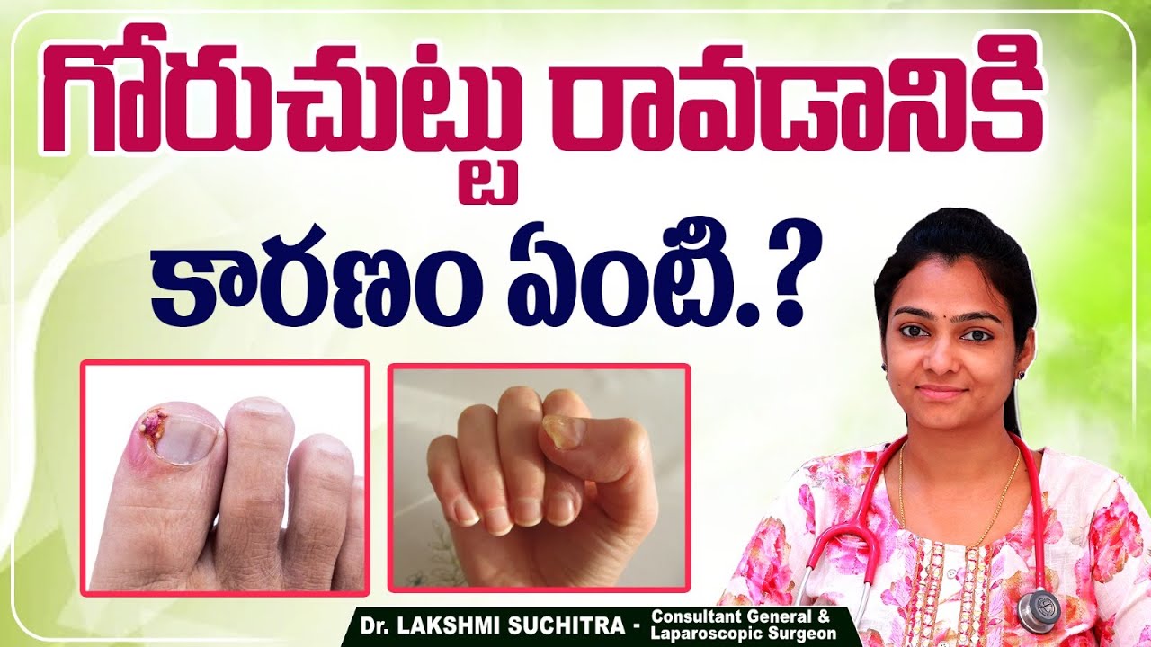 గోరు చుట్టు | Causes and Symptoms of Nail Infection | Paronychia | Goru Chuttu | Sankhya Hospitals
