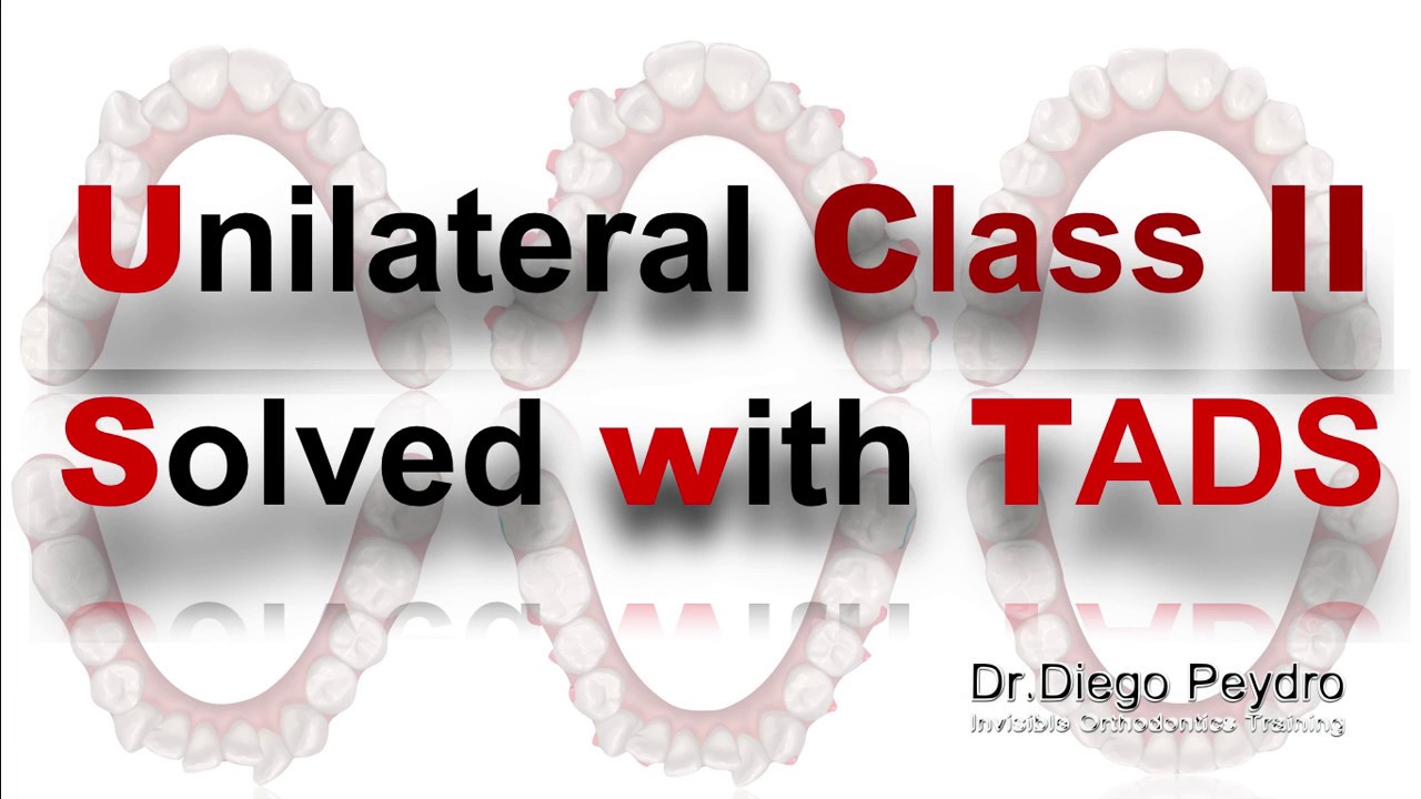 Invisalign and TADS to solve a Severe Class II Malocclusion