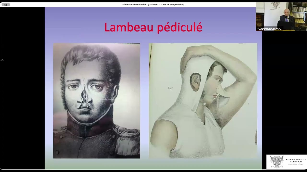 19 Jacques Mathieu Delpech (1777-1832)