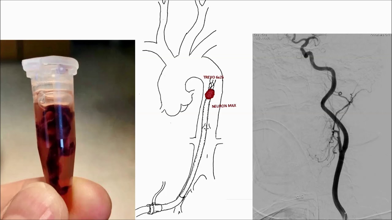 Thrombectomy in acute stroke – can we extend the time window?