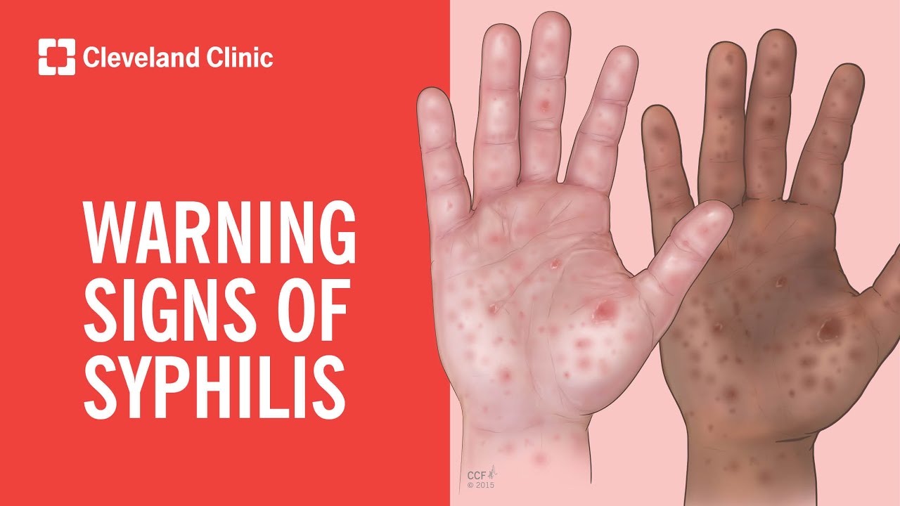 Warning Signs of Syphilis