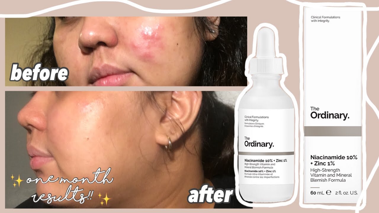 i used THE ORDINARY NIACINAMIDE 10% + ZINC 1% serum for 1 MONTH! (review)