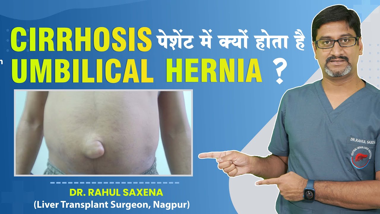 Liver Cirrhosis पेशेंट्स  में क्यों होता है  Umbilical Hernia ?