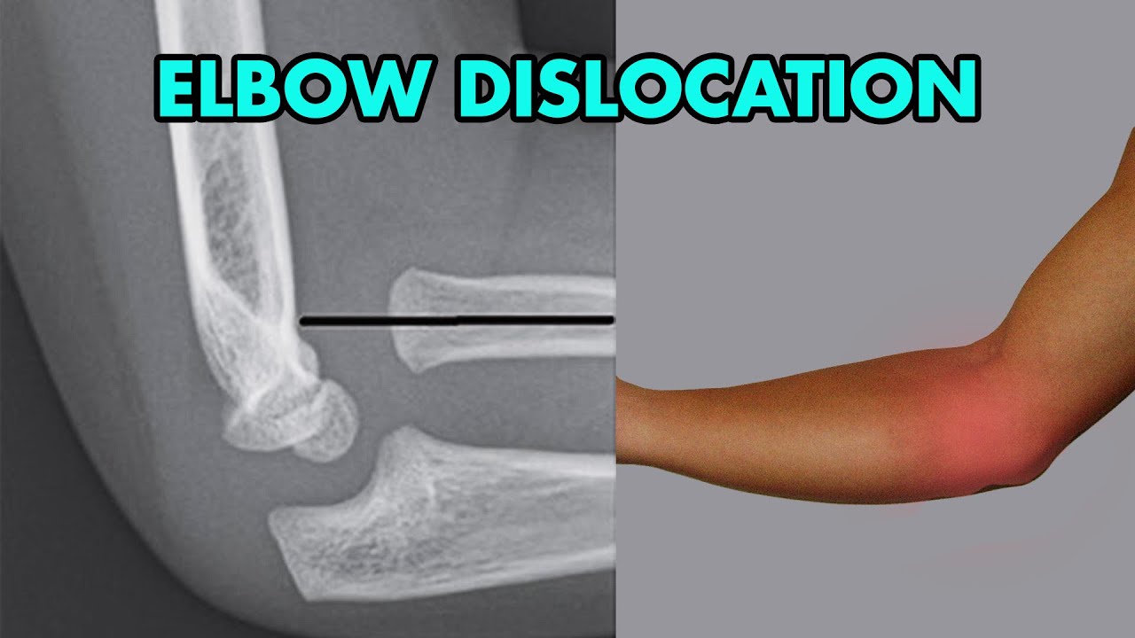 Elbow Dislocation: Reduction Techniques, Diagnosis and Complications