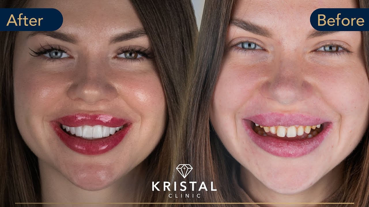 Kristina's E-Max Veneers Transformation in Turkey: Kristal Clinic Beauty Bliss!
