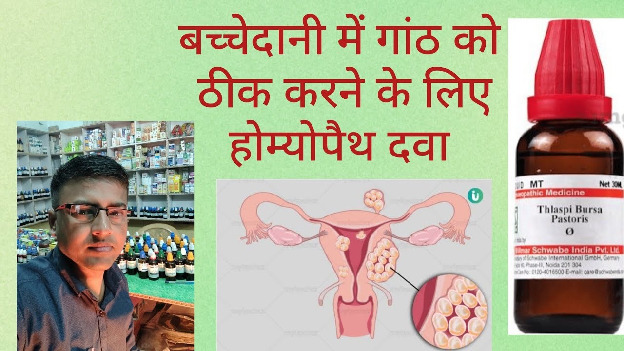 बच्चेदानी में गांठ को ठीक करने के लिए होम्योपैथ में स्पेशल मेडिसिन 
