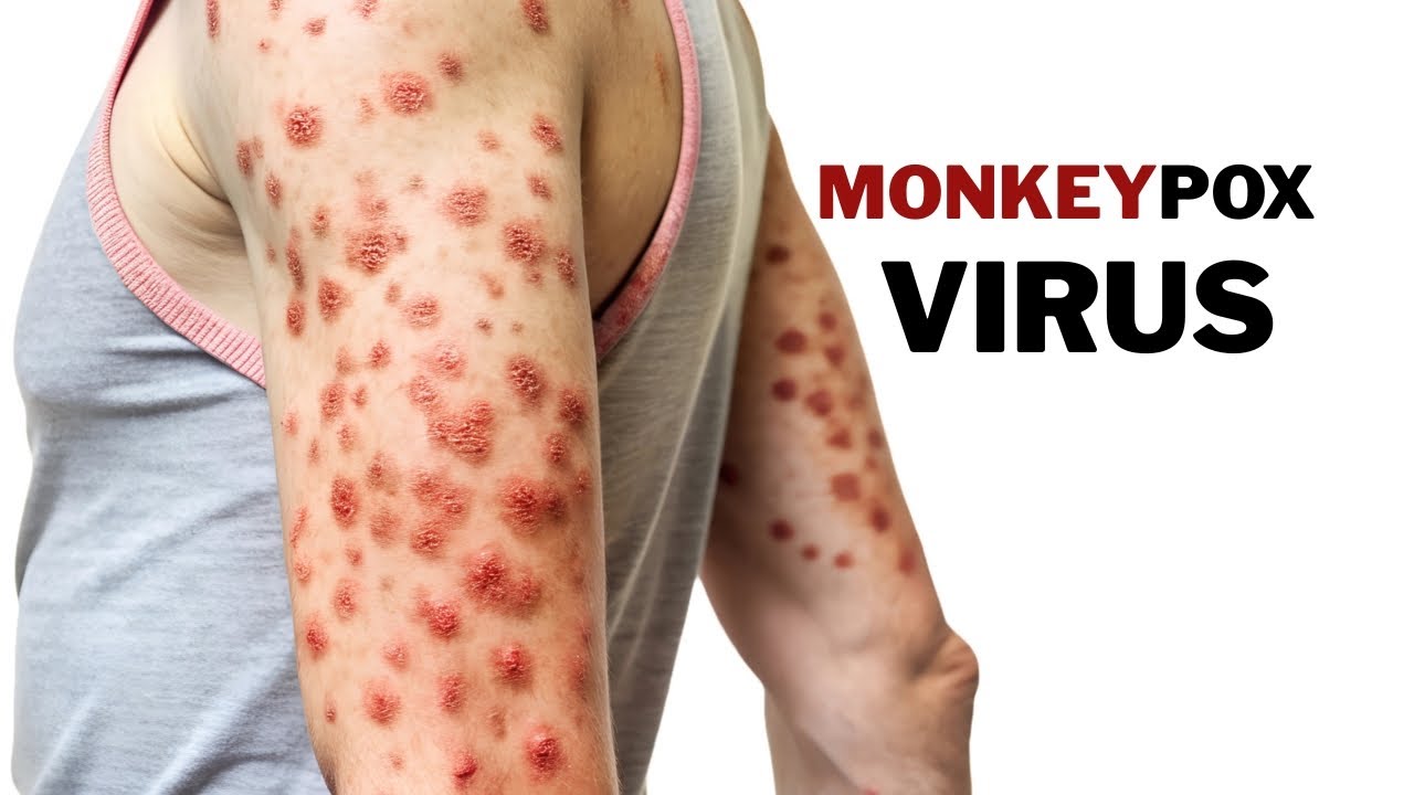What is Monkeypox and how it spreads, prevention and cure Dr. Aryan Mishra