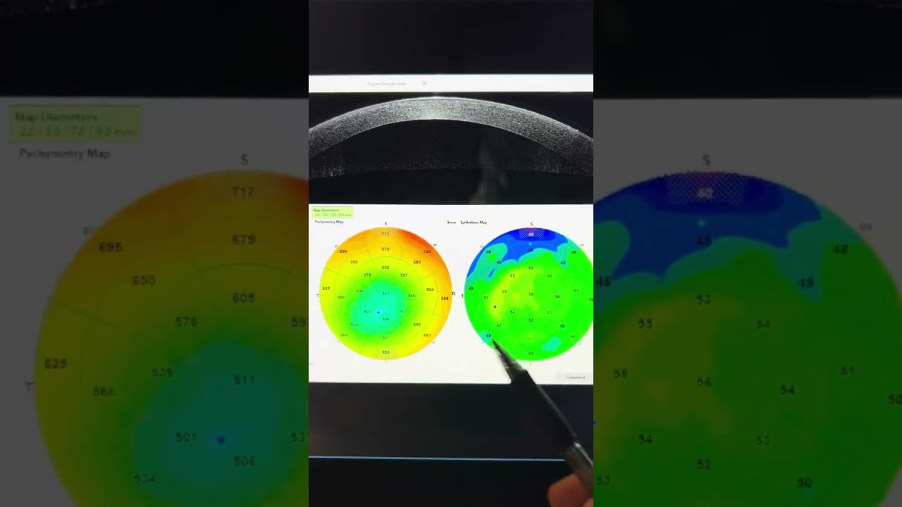 4 years post  Athens protocol in a young female with keratoconus: pentacams epitheliam maps and Va