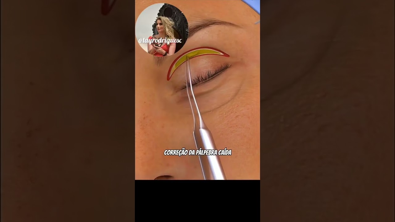 Blefaroplastia conhecida como cirurgia de p&aacute;lpebras. #cirurgiaplastica #plastica #pele #dicas #viral