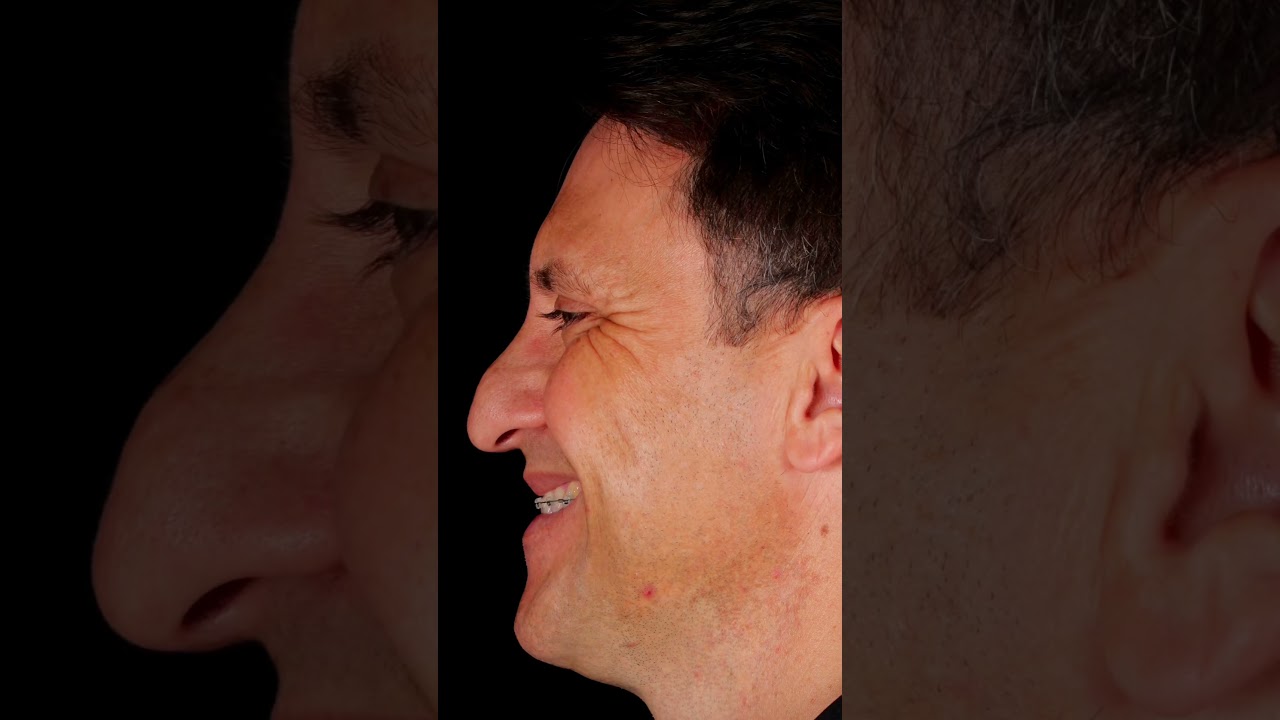 Rinoplastia em Nariz masculino: um transforma&ccedil;&atilde;o!!
