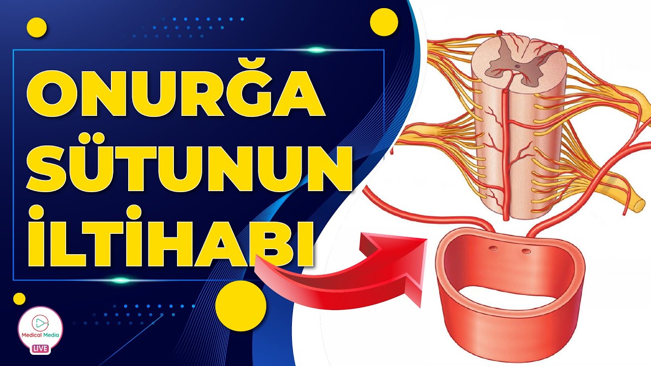 ONURĞA SÜTUNUN İLTİHABI / ONURĞA SÜTUNU XƏSTƏLİKLƏRİ / ONURĞA ŞİŞLƏRİ
