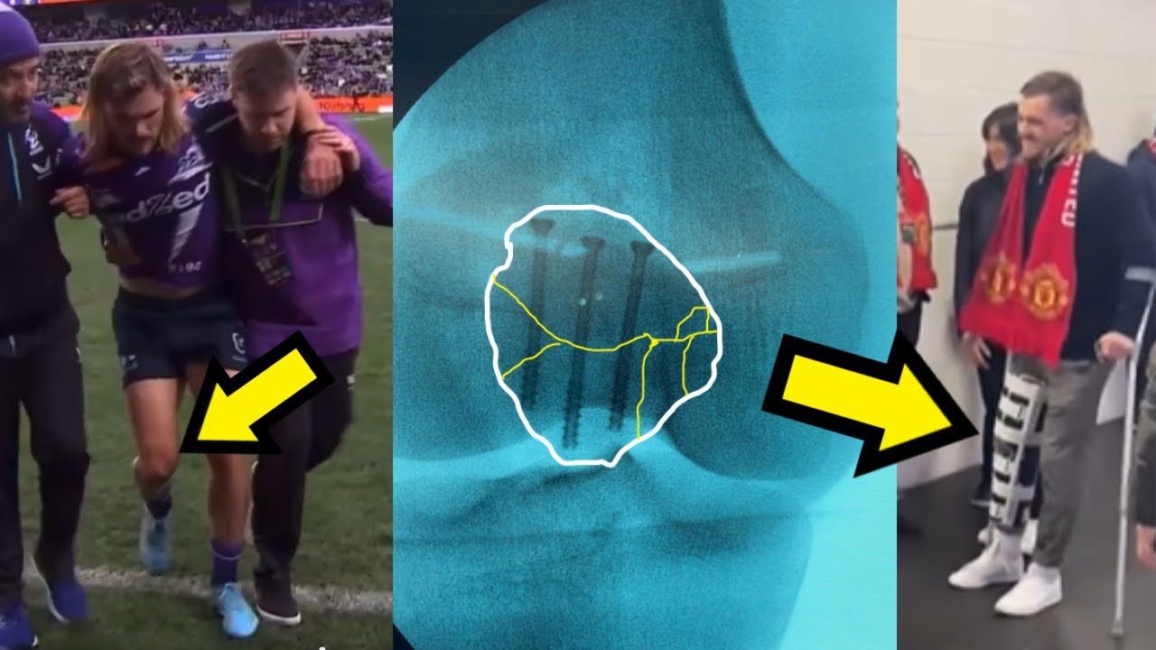 Ryan Papenhuyzen's KNEE SURGERY for Patella Fracture Explained!