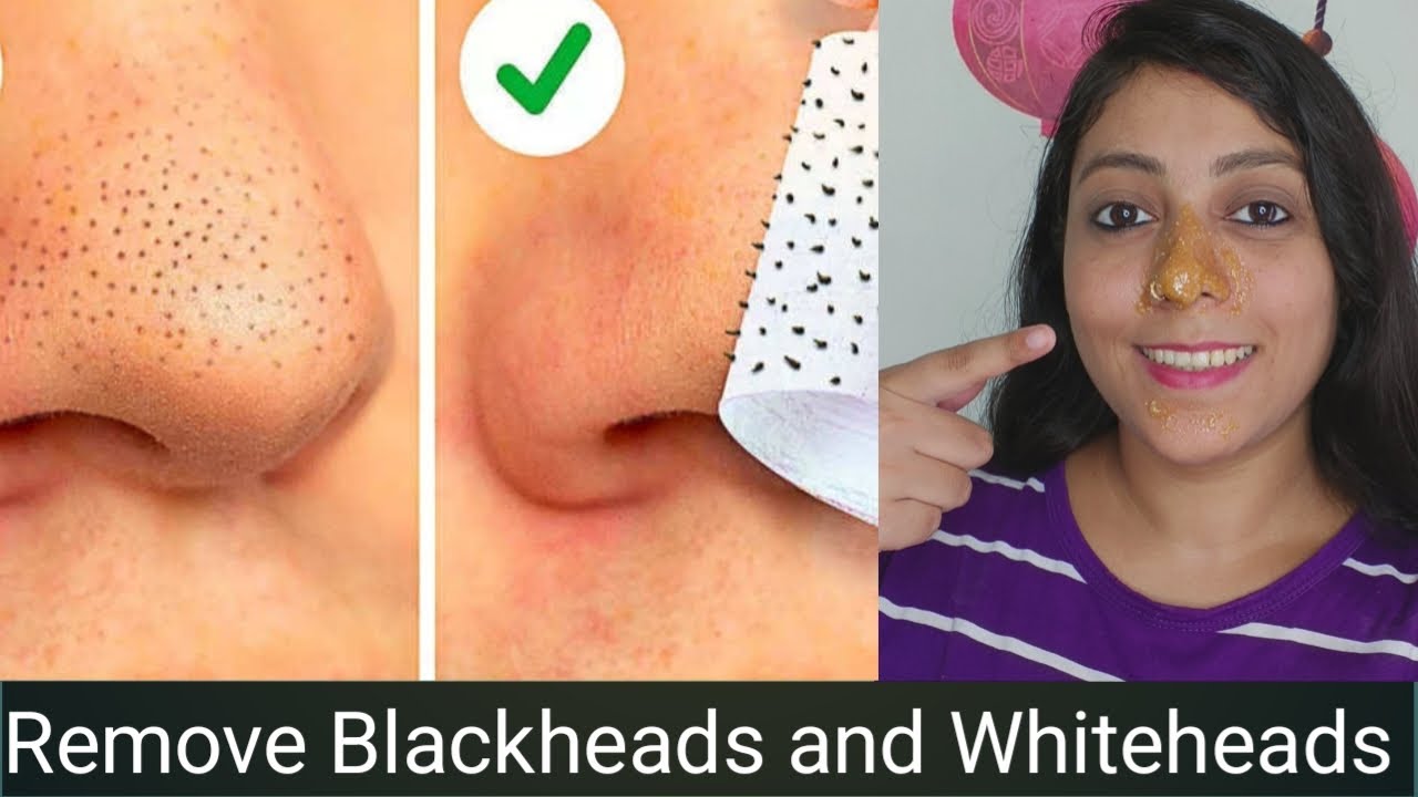 Remove BLACKHEADS / WHITEHEADS at home in just 2 minutes/How to remove Blackheads from nose