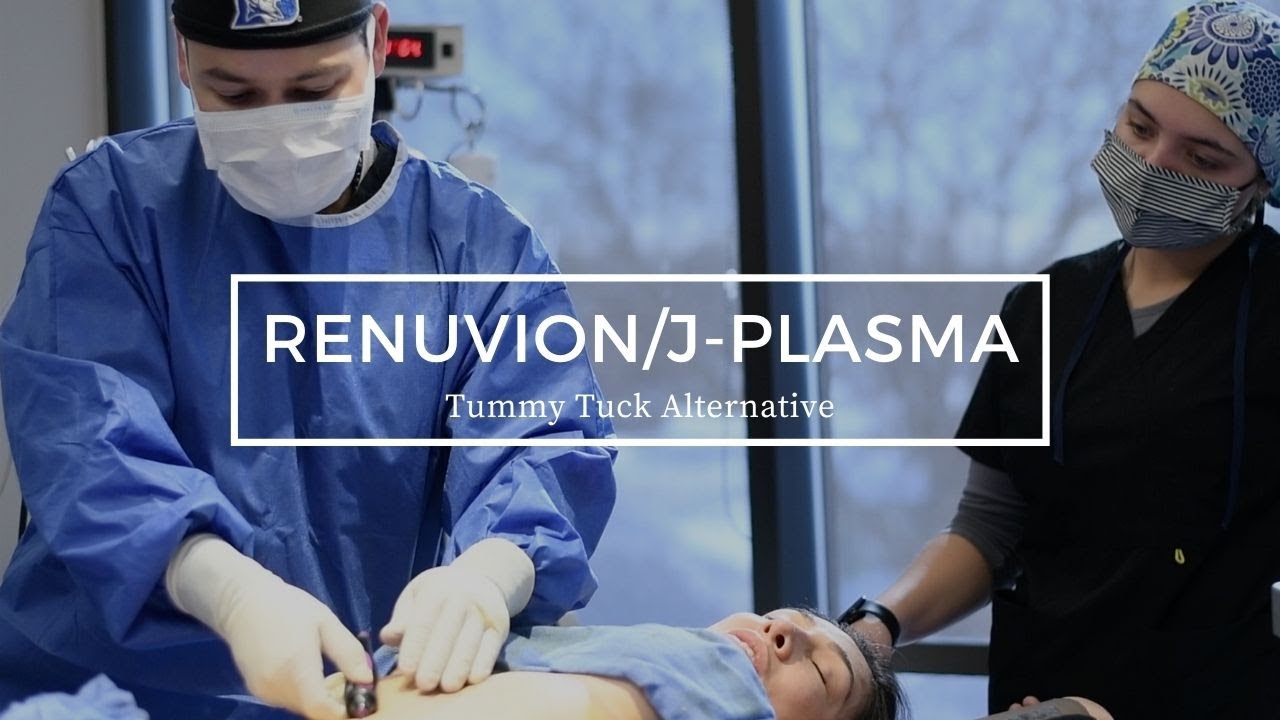 Renuvion/J-Plasma - Tummy Tuck Alternative?