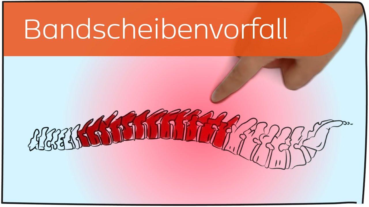 Bandscheibenvorfall in 3 Minuten erkl&auml;rt