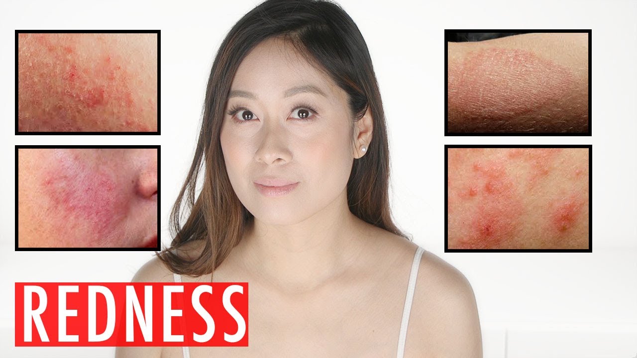 Redness On Face | Causes | Products To Get Rid of Red Skin