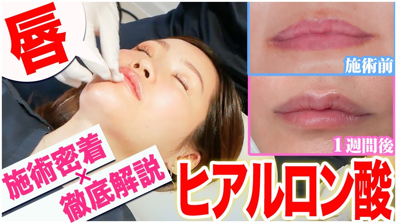 【唇のヒアルロン酸】注入量はどのくらい？施術前からダウンタイムまで公開します