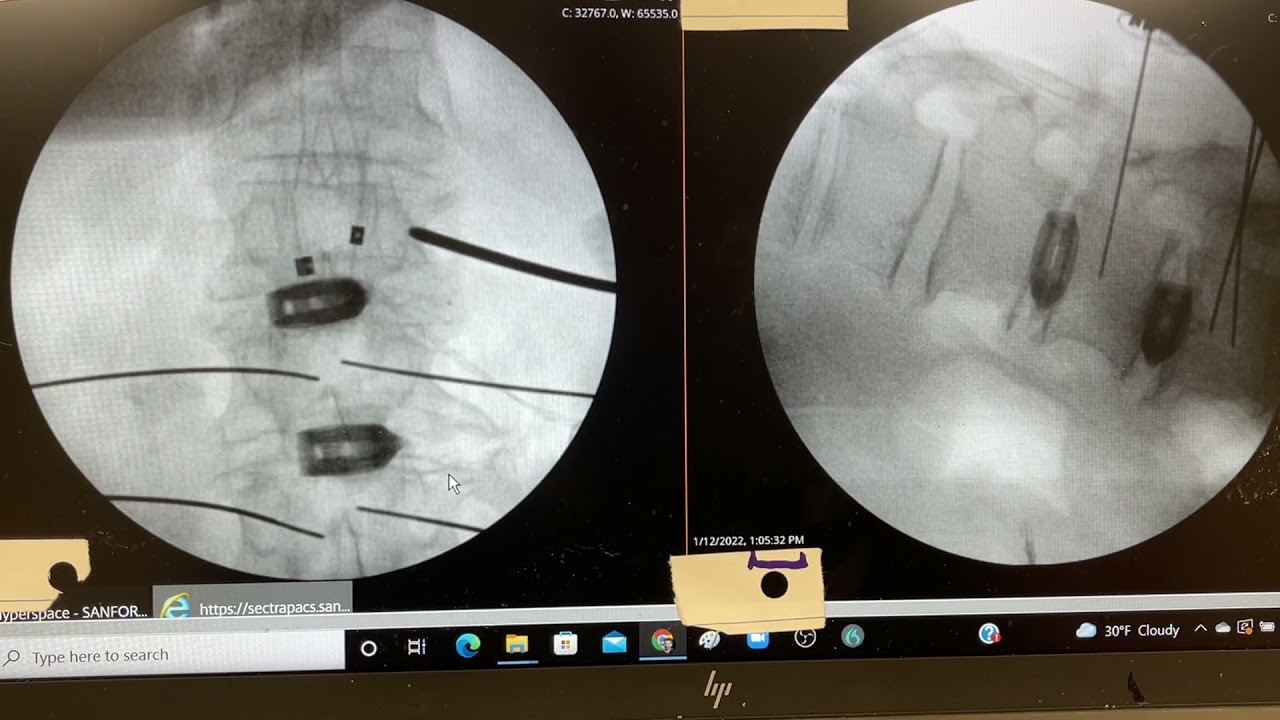 Minimally invasive T12-L3 trans kambin spinal fusion in 75 minutes