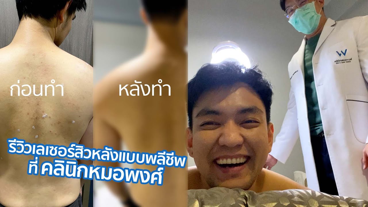 VLOG : รีวิวเลเซอร์สิวหลังแบบพลีชีพ