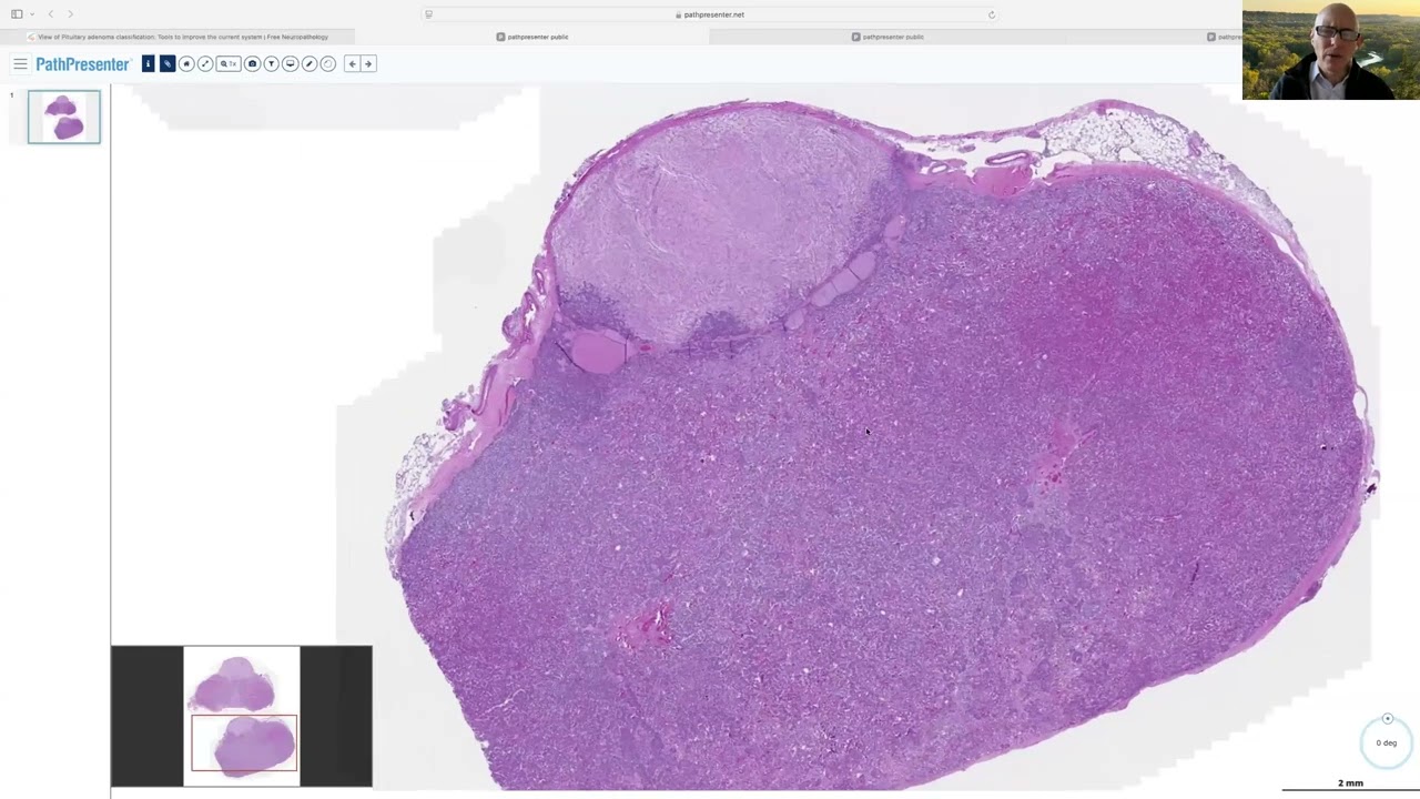 AANP Teaching Rounds - February 26, 2025 - PitNET/Pituitary Adenoma Classification: Survival Tips