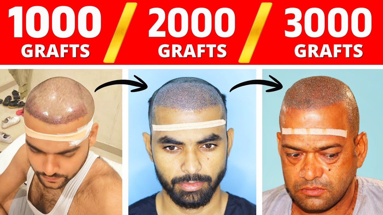 Hair Transplant Result In 18, 25, 30 and 50 Years🔥 Best Age For Your Hair Transplant 