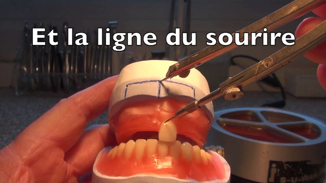 Montage de prothèse complète haut et bas en commençant par l'inférieur