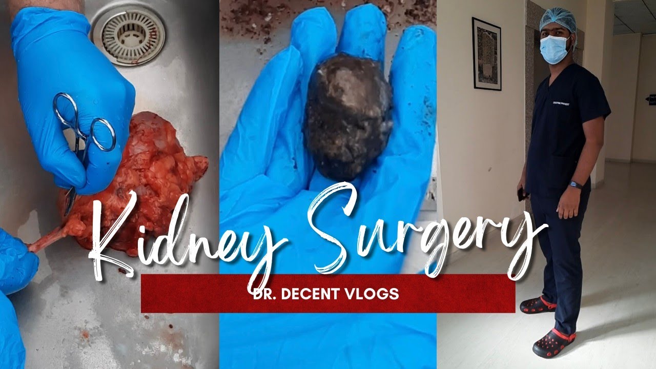 Kidney stone surgery - urology hospital | Dr. Decent Vlogs
