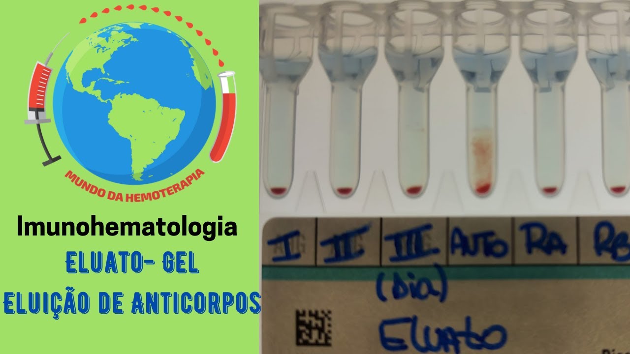Eluato - Eluição de Anticorpos - Coombs Direto Positivo - Imunohematologia - Banco de Sangue