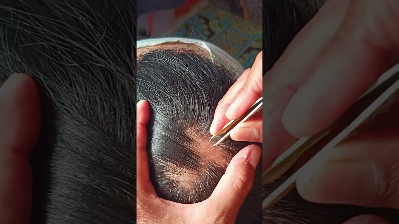 most satisfying white hair removal 0.86#satisfying #stressremoval