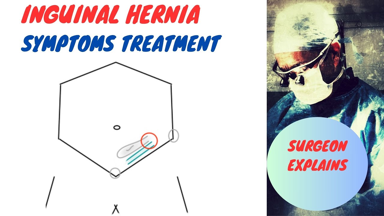 Inguinal Hernia Symptoms and Treatment
