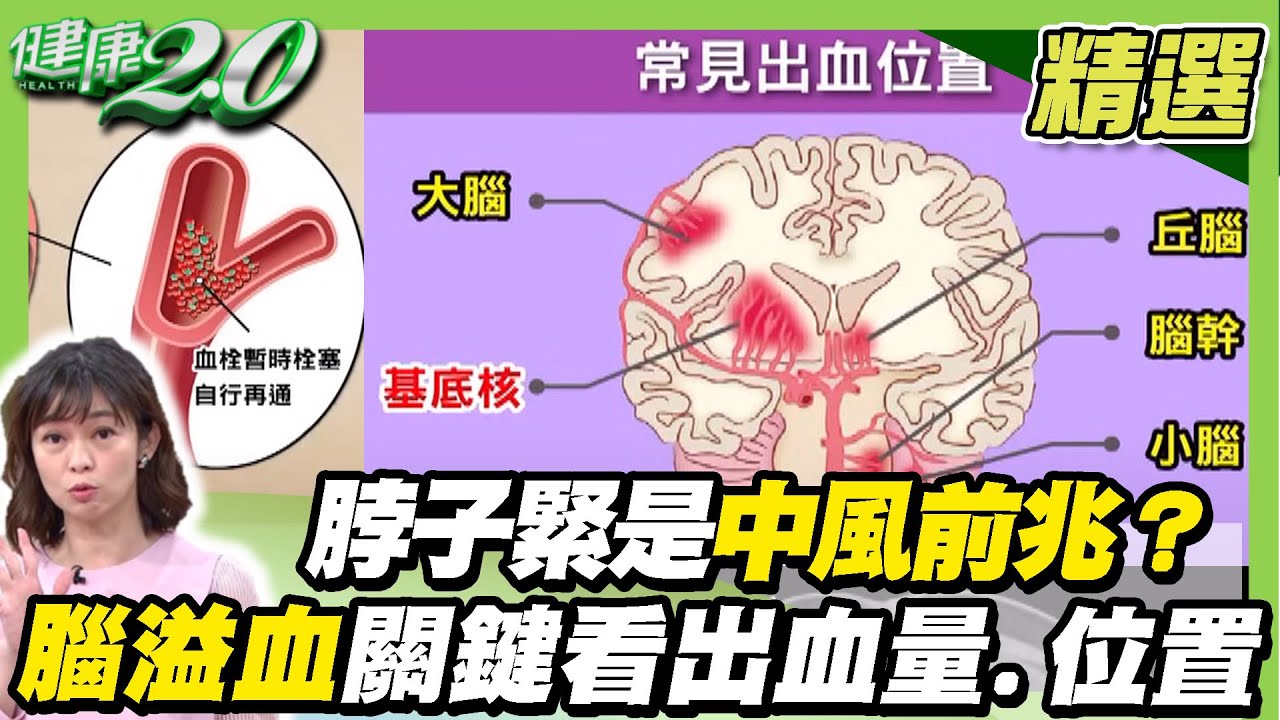 黃金治療3小時 腦溢血關鍵看出血量.位置！脖子緊緊是中風前兆？當心頸動脈狹窄昏眩！【健康2.0精選】