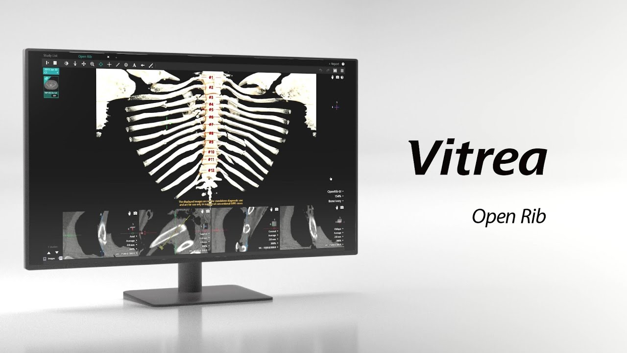 Vitrea Automated Workflow Open Rib | Unfolded Rib View