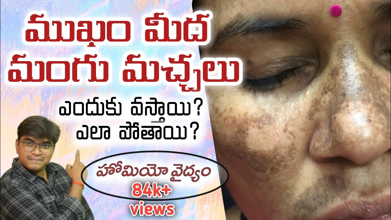 How to Remove Spots On Face at Home | Melasma Homeopathy treatment | మంగు మచ్చలు పోవాలంటే