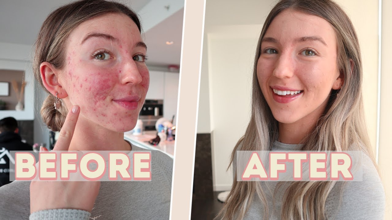 My Acne Makeup Routine // Acne Positivity