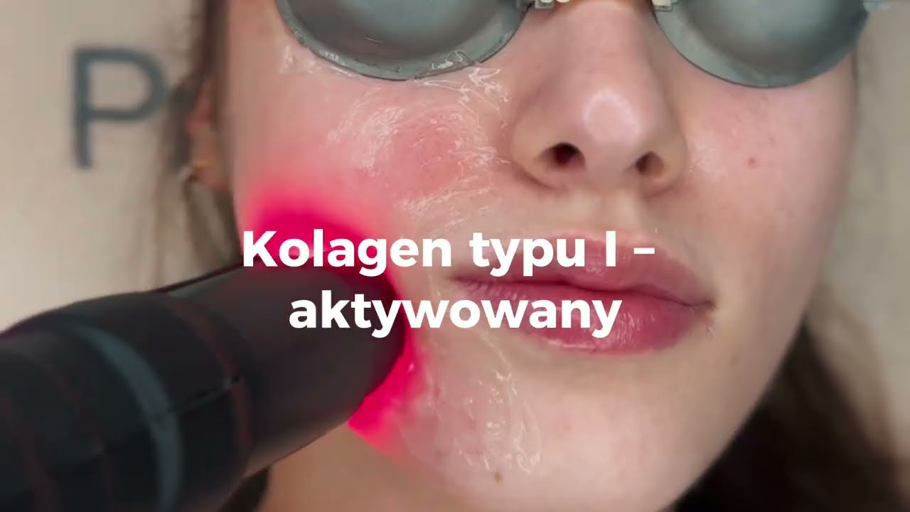 Red Touch Pro nieablacyjny zabieg laserowy stosowany w celu poprawy jakości i wyglądu sk&oacute;ry twarzy.