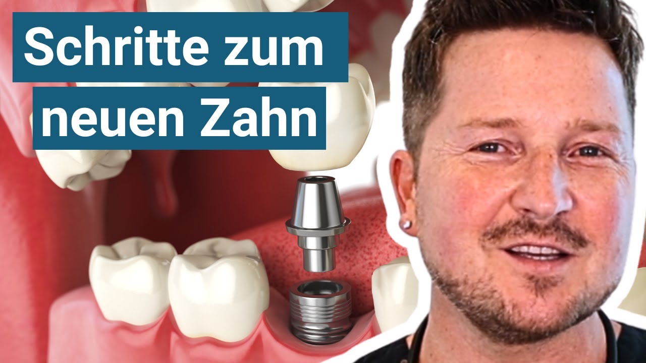 So werden neue Z&auml;hne bei dir implantiert (Zahnarzt erkl&auml;rt)