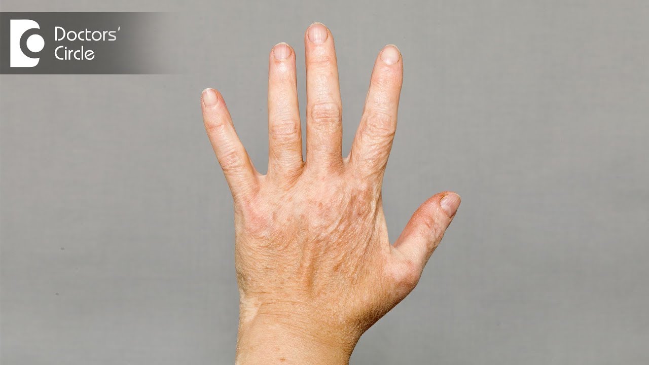 What are the causes of Vitiligo & how does it advance? - Dr. Roshan Reddy