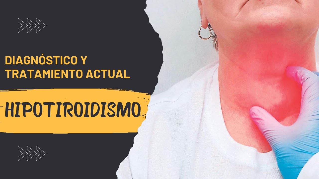 ¿Cómo diagnosticar y tratar el Hipotiroidismo Clínico y Subclinico?