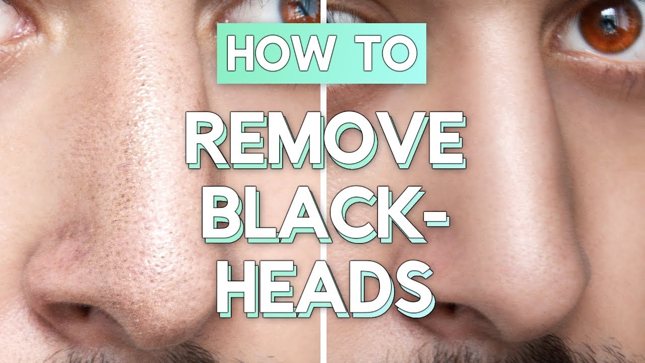 No Bullsh*t Blackhead Removal - How To Remove Blackheads From Face / Nose ✖ James Welsh