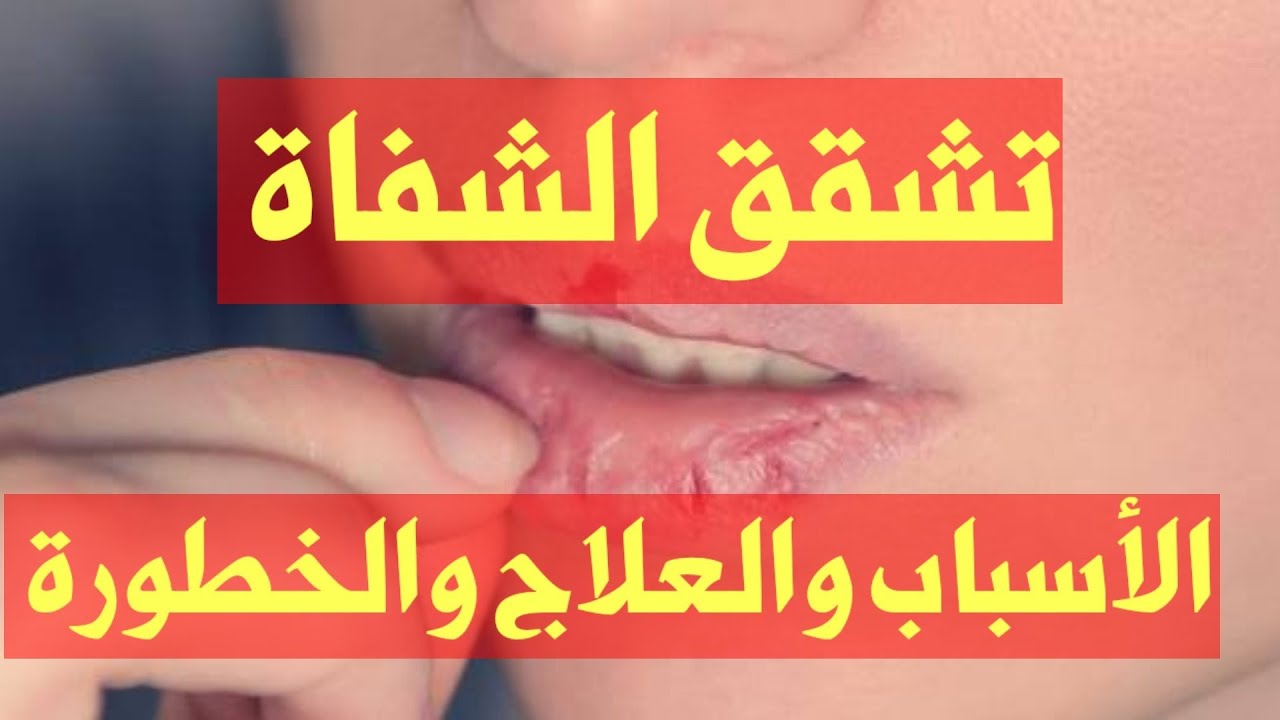 هذه الاسباب لن تتوقعيها تسبب تشقق الشفتين...علاج تشقق الشفايف_مع الدكتور